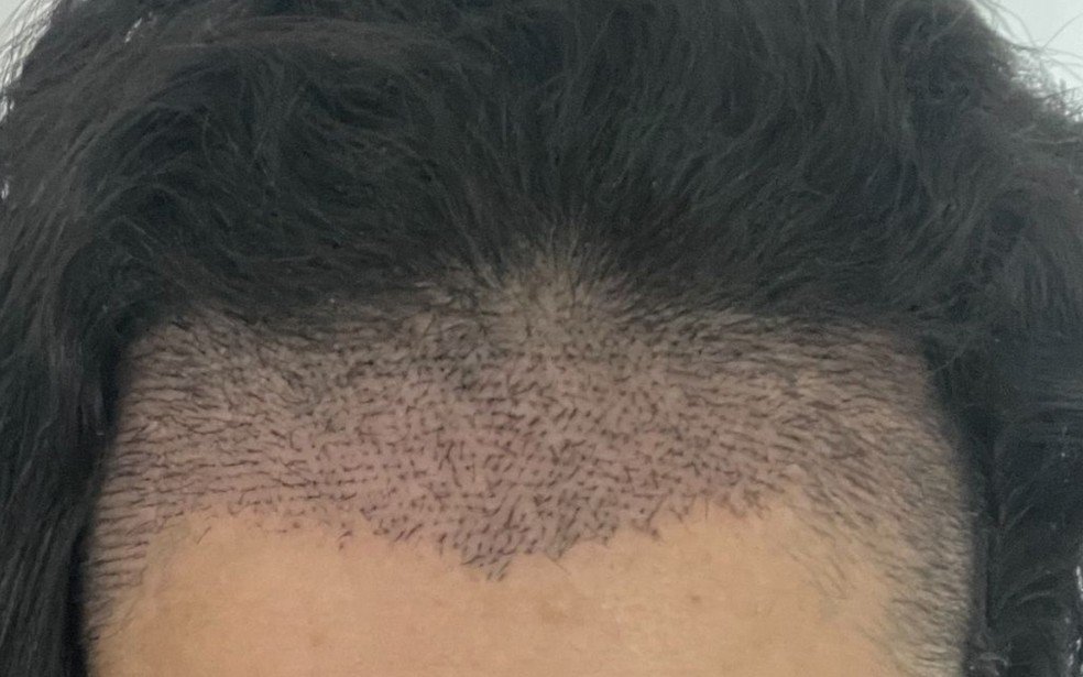 Transplante capilar emerge como alternativa robusta para indivíduos com alopecia, impactando bem-estar - Imagem do artigo original