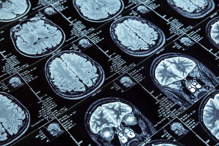 Avanços No Combate Ao Alzheimer em 2025: Cinco Descobertas - Imagem do artigo original
