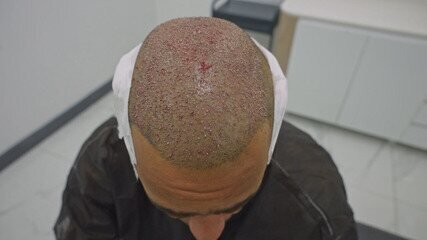 Transplante Capilar na Turquia: Luxo e Resultados em Istambul - Imagem do artigo original