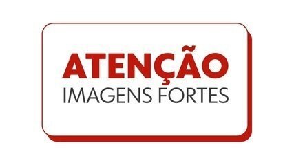Modelo relata necrose grave após estética em SC - Imagem do artigo original