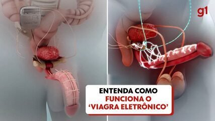 Estudo Pioneiro Restaura Ereção em Paraplégicos com Dispositivo - Imagem do artigo original