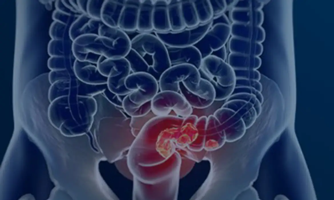 SUS Pode Ganhar Rastreamento Organizado para Câncer Colorretal - Imagem do artigo original