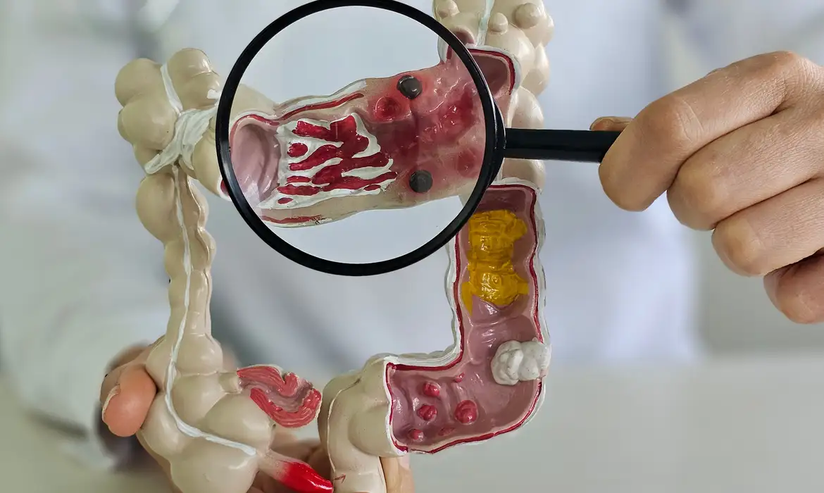 Doença Inflamatória Intestinal Cresce Cinco Vezes no Brasil - Imagem do artigo original